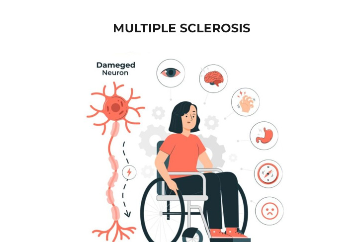 Multiple-Sclerosis
