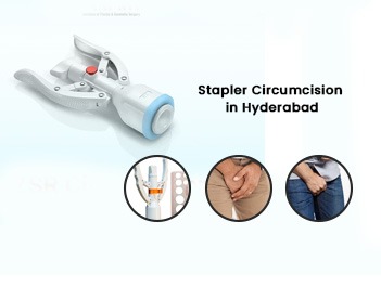 Stapler Circumcision in Hyderabad